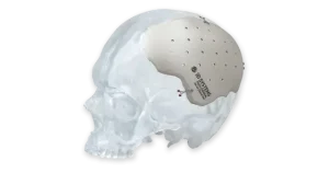 Craniomaxillofacial Implants
