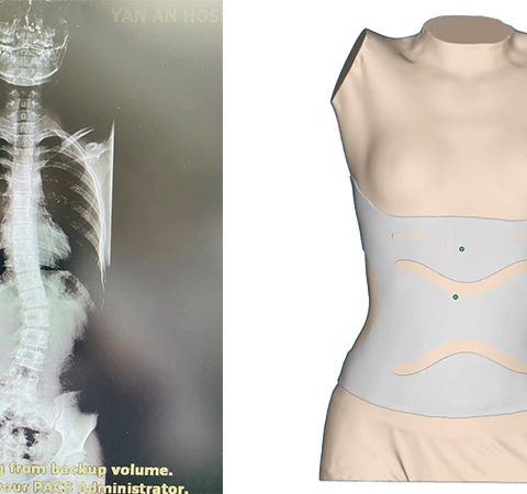 Quét 3D cơ thể để chế tạo khung chỉnh hình